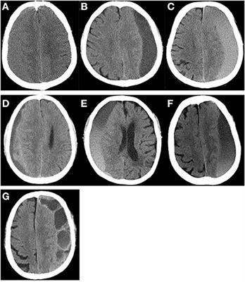 Brain re-expansion predict the recurrence of unilateral CSDH: A clinical grading system